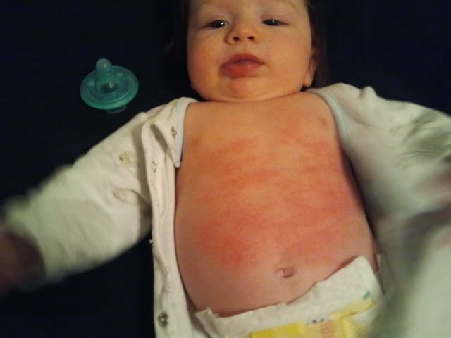 what-s-this-rash-on-bb-s-tummy-pic-added-babycenter