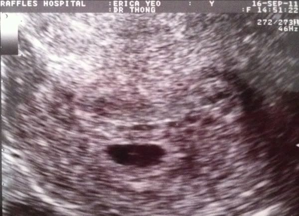 Karissa as an embryo