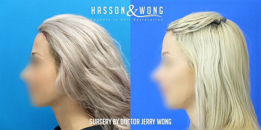 hair-transplant-surgery-before-after-1372-grafts-left-profile-FUT_zpsody538v8