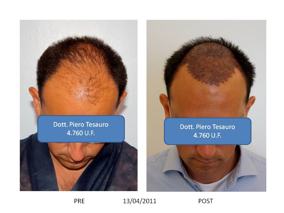 trapianto capelli tesauro trapianto capelli tesauro