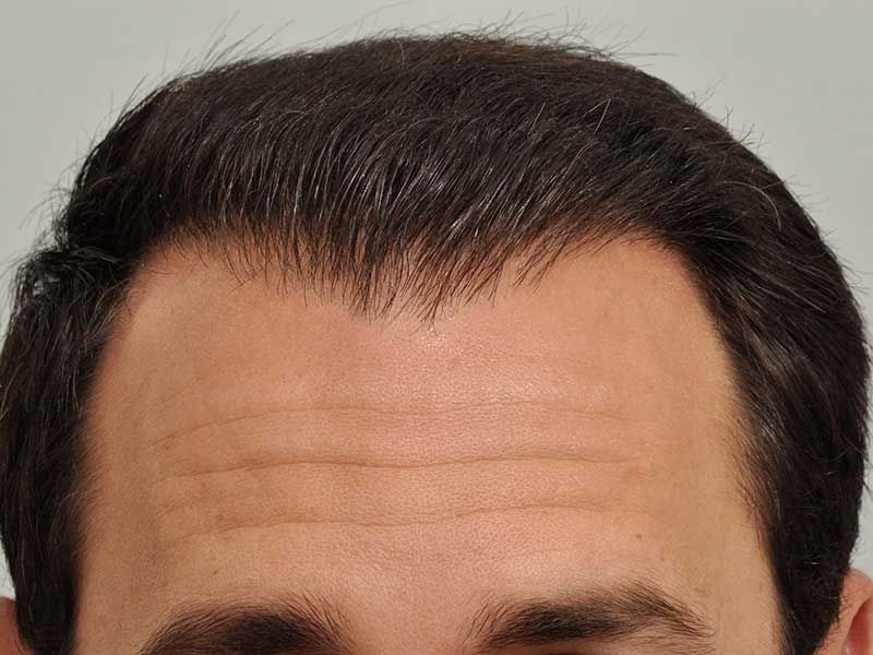 Patient_RRW_After_Natural_Hairline_zps1cd326ce