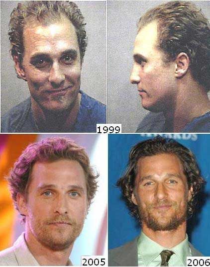 matthew-McConaughey-hair-transplant