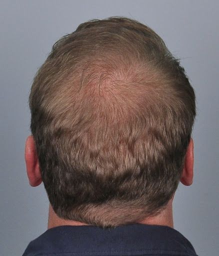 tn_hair-transplant-charlotte-4693-8_zpsguclejq0