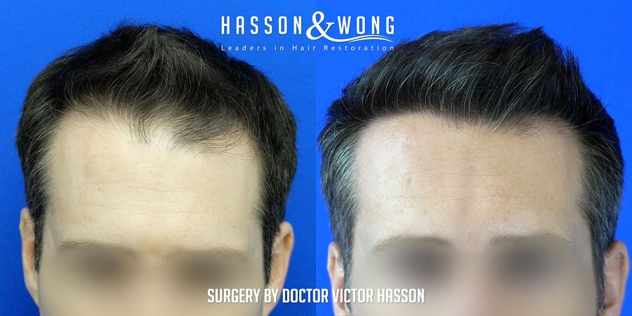 hair-transplant-surgery-after-4699-grafts-after-front-close-FUE_zpsavnza1gt