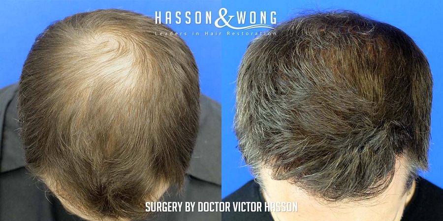 hair-transplant-surgery-after-4699-grafts-after-front-tilt-FUE_zpsabu5hb8l
