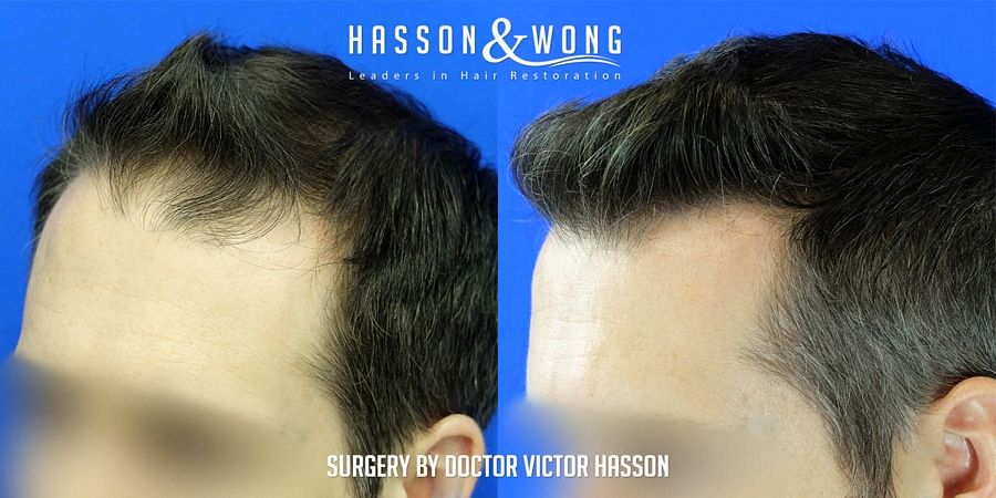 hair-transplant-surgery-after-4699-grafts-after-left-close-FUE_zpsfswcu3zy