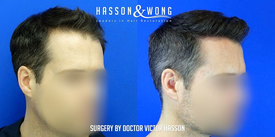 hair-transplant-surgery-after-4699-grafts-after-right-FUE_zpst46co7li