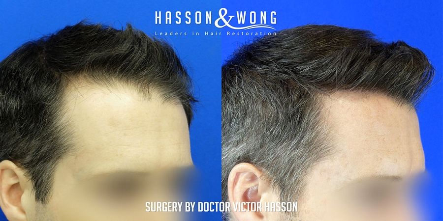 hair-transplant-surgery-after-4699-grafts-after-right-close-FUE_zps7sy9thec