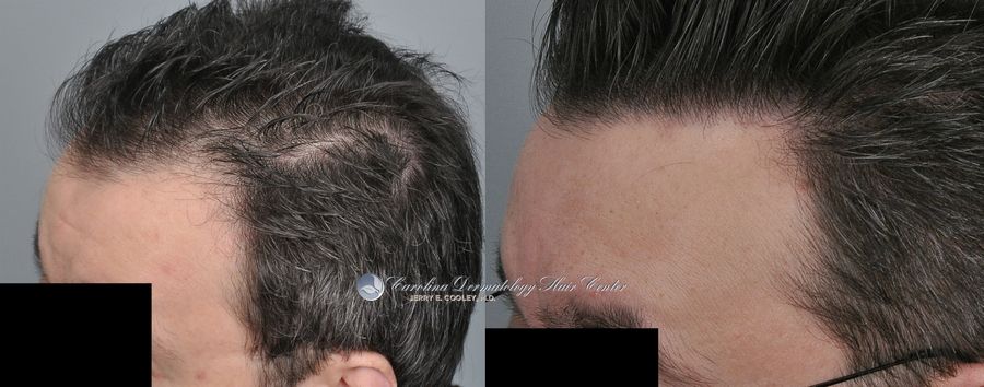 tn_hair-transplant-north-carolina-2407-strip-18-months-5_zpspvcxfqh2