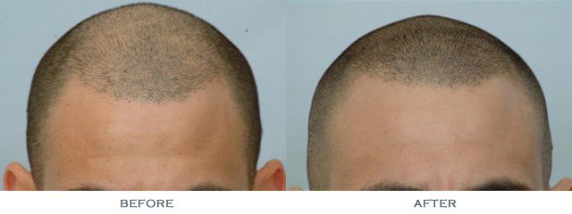 phoca_thumb_l_before-and-after-1600-grafts-front-comparison_zpstbqni6sr