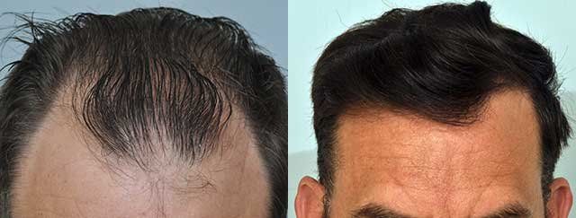 phoca_thumb_l_patient-smp-before-after-front-hairline_zpss8wudhca