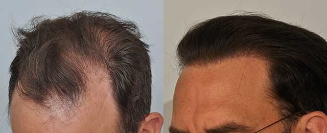 phoca_thumb_l_patient-smp-before-after-left-side-dry-hair_zpsbmo08xxr