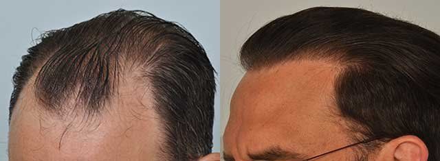 phoca_thumb_l_patient-smp-before-after-left-side-wet-hair_zpsmwtz1aan