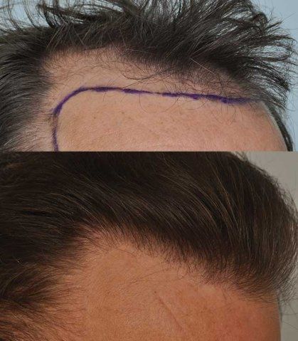 phoca_thumb_l_patient-smp-before-after-right-side-close-hairline_zpsgvszsend